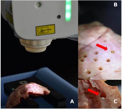 High Precision Bone Cutting by Er: YAG Lasers Might Minimize the Invasiveness of Navigated Brain Biopsies